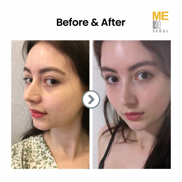 Ultherapy before and after photos > Blog - ME CLINIC SEOUL